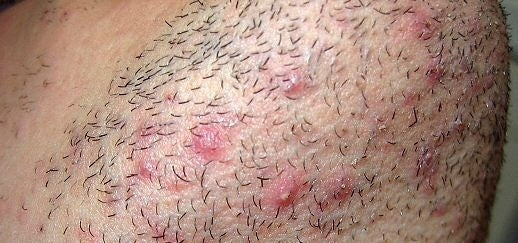 Comment Faire Disparaître les Poils Incarnés