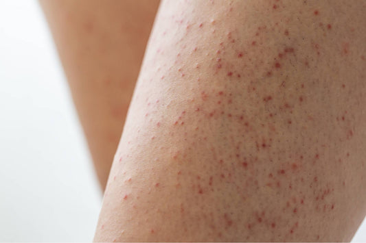Dites adieu à la kératose pilaire grâce au gant en soie : La solution douce et naturelle pour une peau lisse et sans imperfections