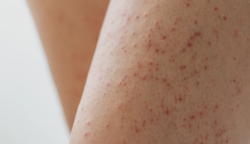 Exfoliation et poils incarnés : pourquoi c'est la solution la plus efficace