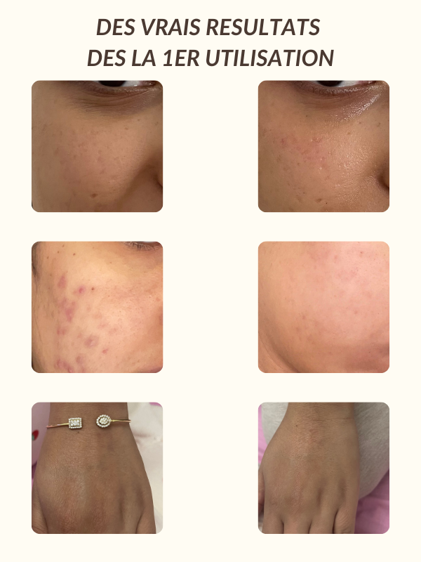 Rituel peau sans tâches 14 jours